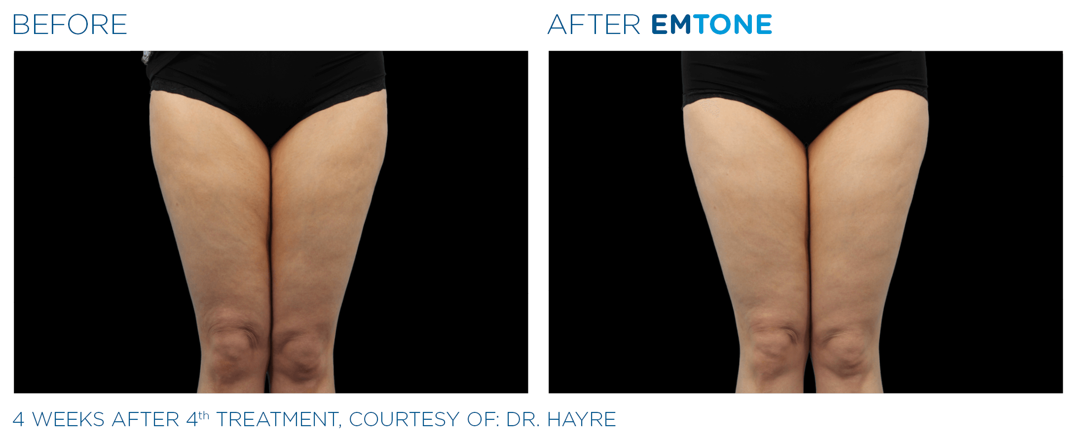 Before and After Cellulite Reduction 2