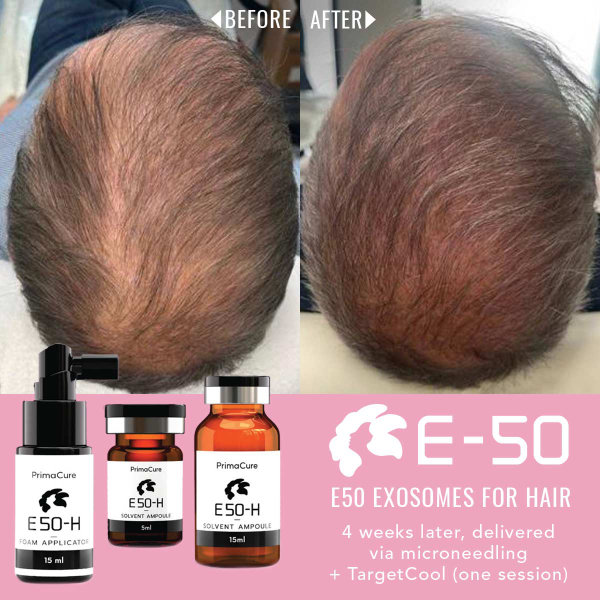 Exosomes for Hair Before & After