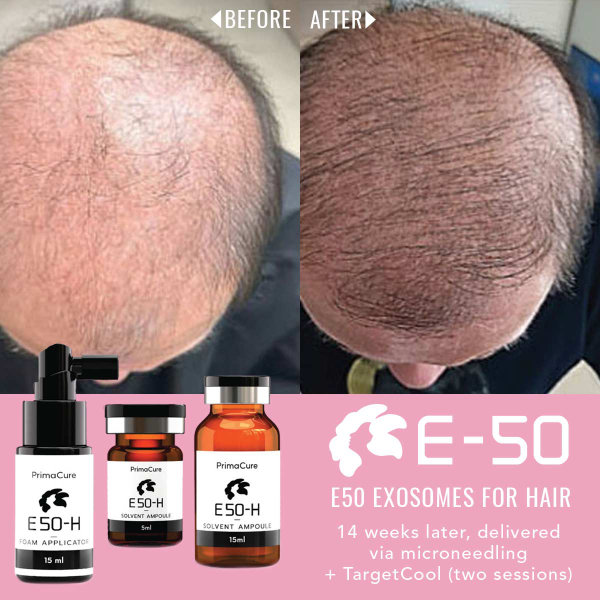Exosomes for Hair Before & After