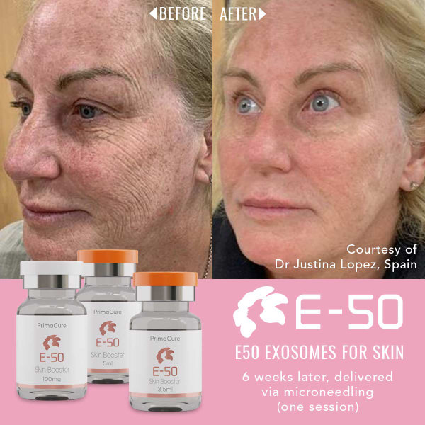 Exosomes Before & After