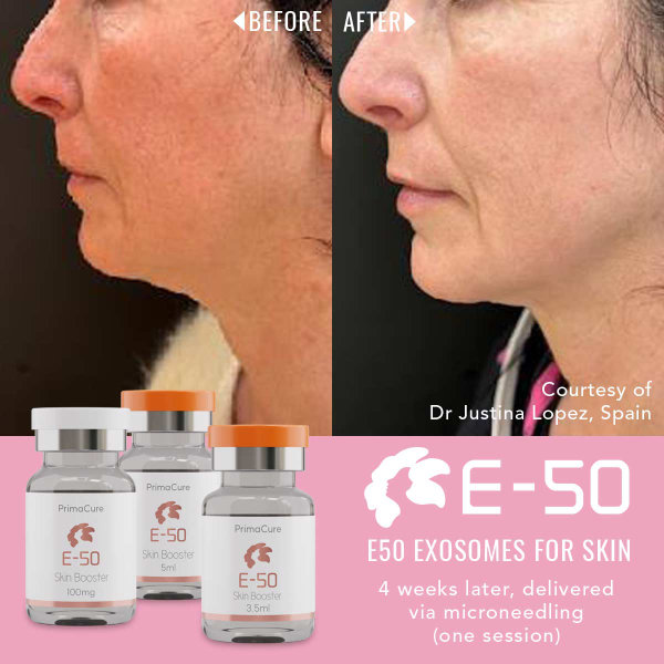 Exosomes Before & After