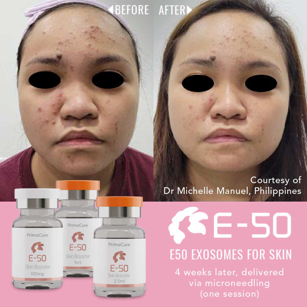 Exosomes Before & After