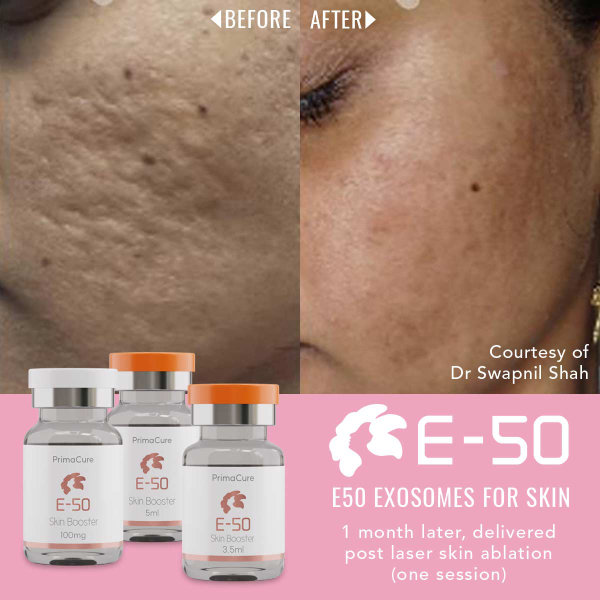 Exosomes Before & After