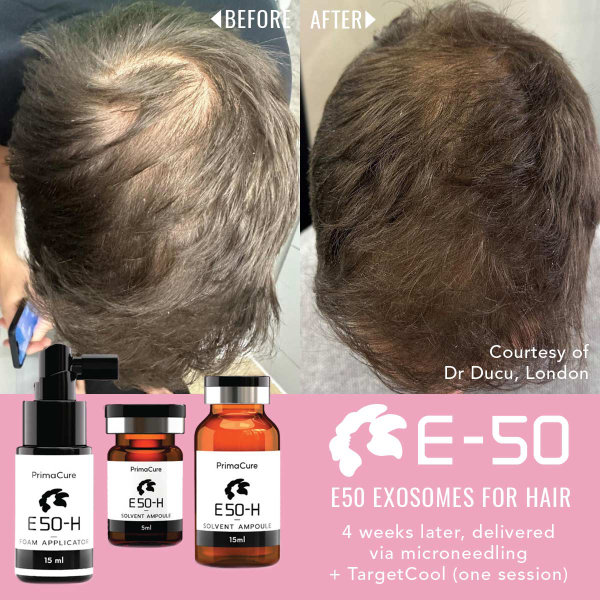 Exosomes for Hair Before & After
