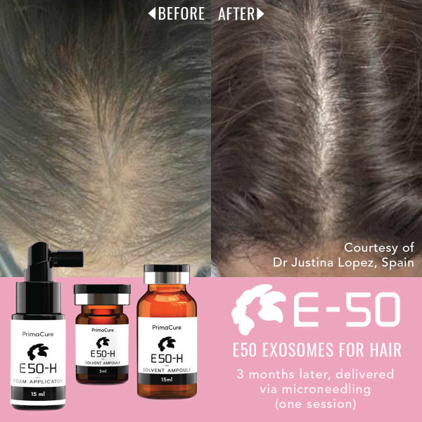 Exosomes for Hair Before & After