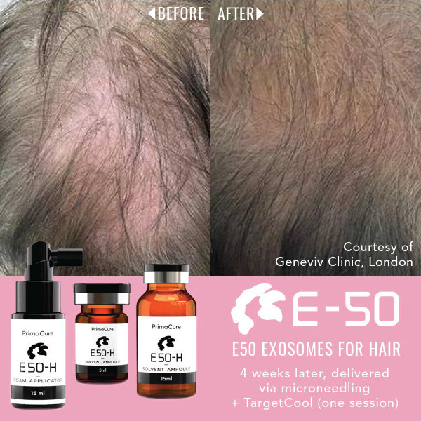 Exosomes for Hair Before & After