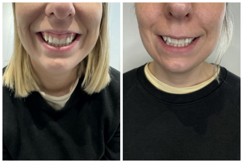 Gummy Smile Before & After-2 Gummy Smile Before & After