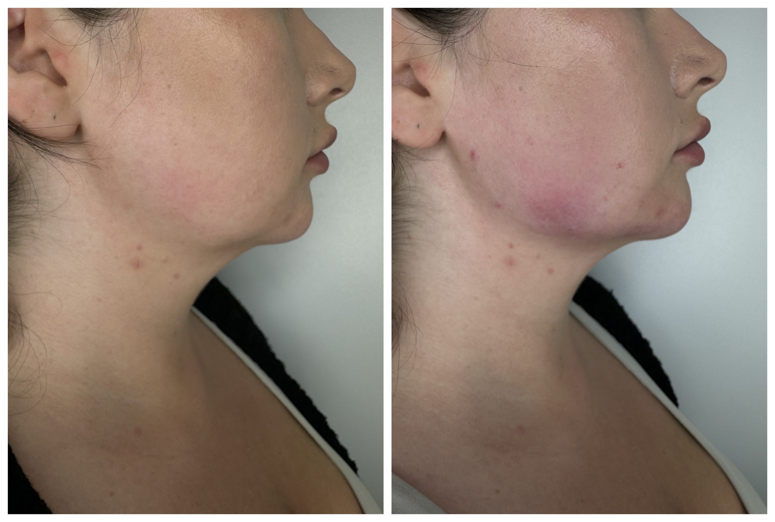 Jawline Enhancement BA-1 Jawline Enhancement Before and After