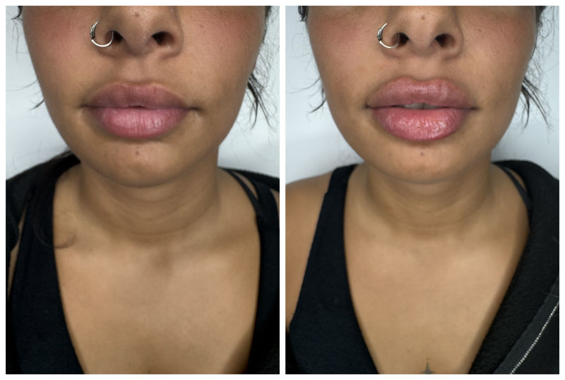 Russian Lips Before and After