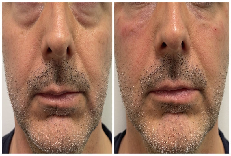 Tear Trough Before & After