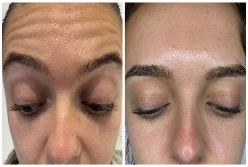 Upper Face Anti-Wrinkle Before and After