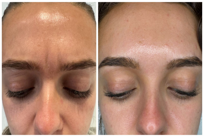 Upper Face Anti-Wrinkle Before and After