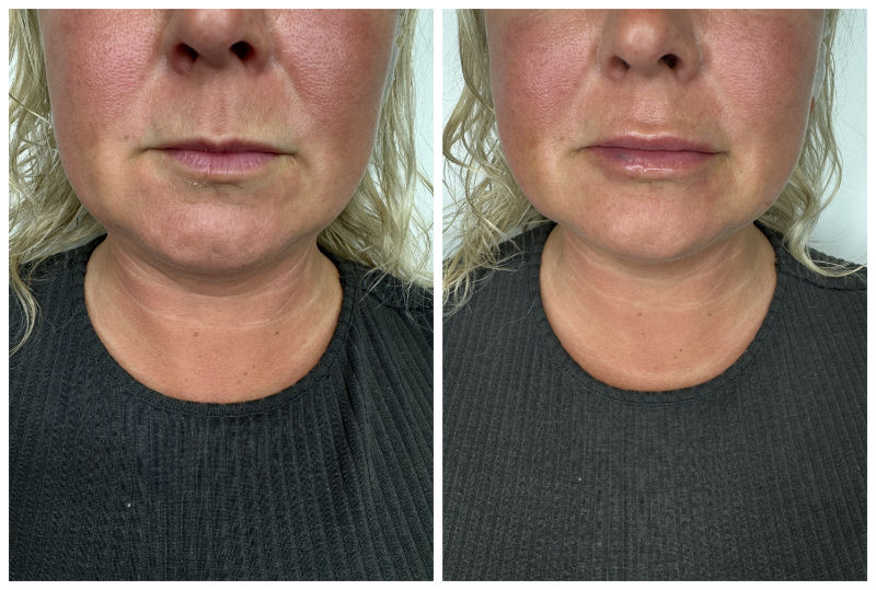 Lip Augmentation Before and After