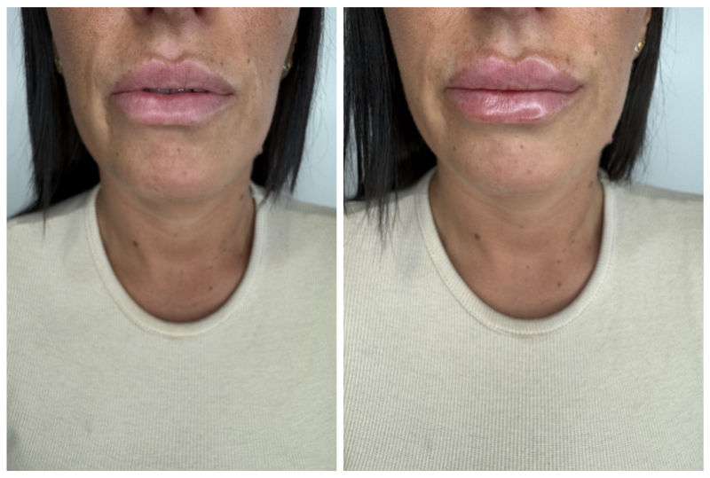 Lip Filler Nottingham Before and After