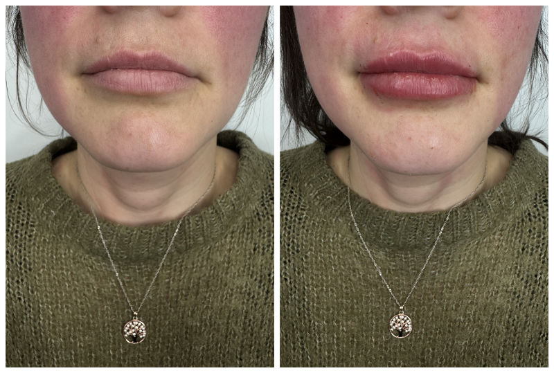Lip Filler Before and After 01