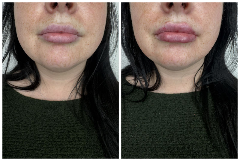 Lip Injections Before and After