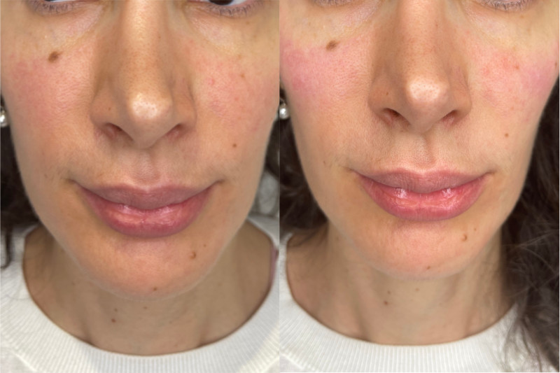 Cheek Filler Before and After