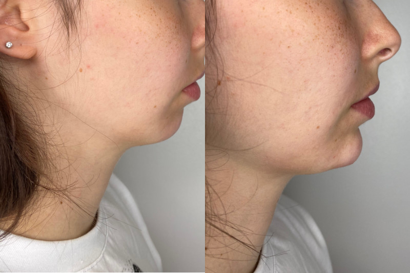 Chin Filler Before & After