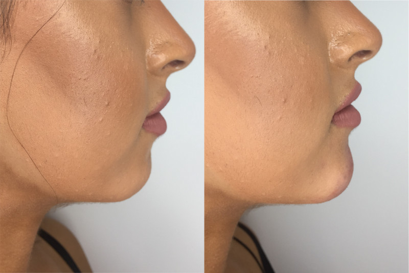 Chin Filler Before & After