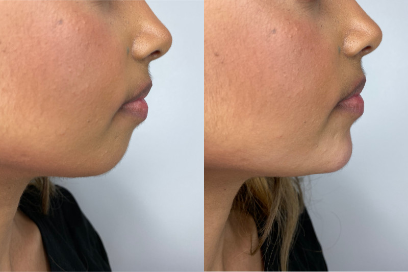 Chin Filler Before & After