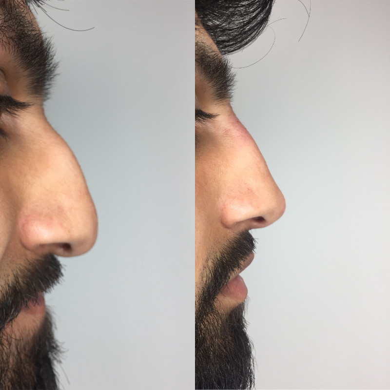 Non-Surgical Rhinoplasty Before & After