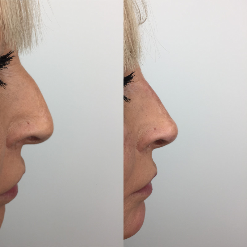 Non-Surgical Rhinoplasty Before & After