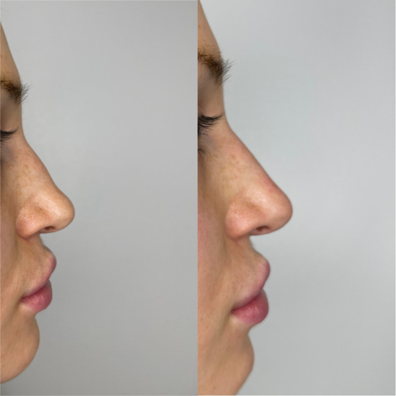 Non-Surgical Rhinoplasty Before & After