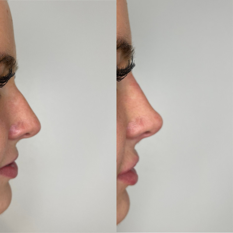 Non-Surgical Rhinoplasty Before & After