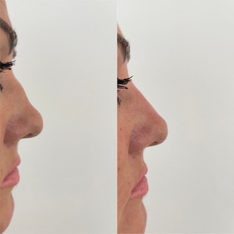 Non-Surgical Rhinoplasty Before & After