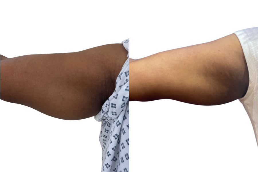 Vaser liposuction arms before and after