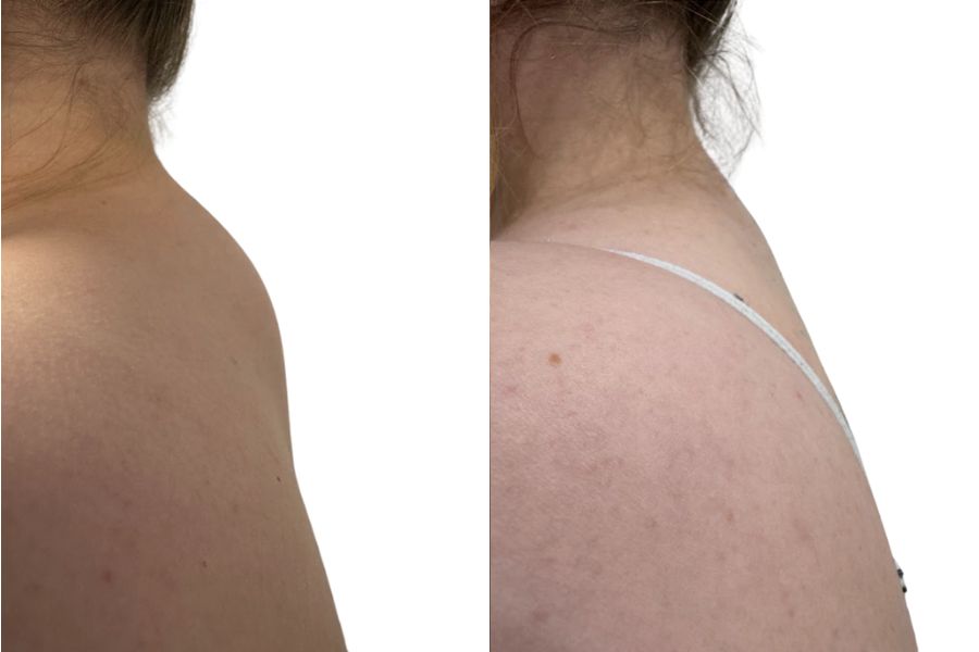 Vaser liposuction upper back before and after
