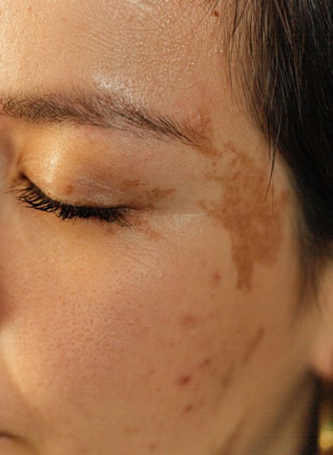 Hyperpigmentation rectangle image 2