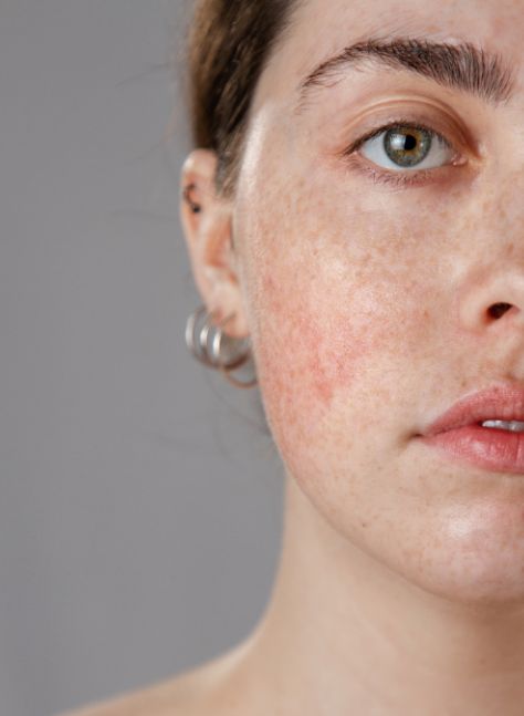 Rosacea