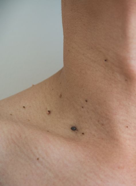 Skin Tags removal rectangle